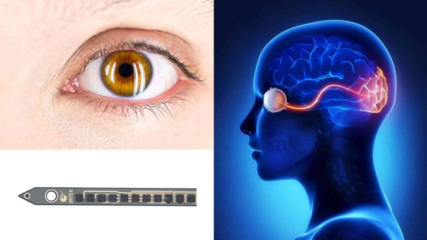 Collage of images showing an eye, how the eye is conncted to the brain and an implant